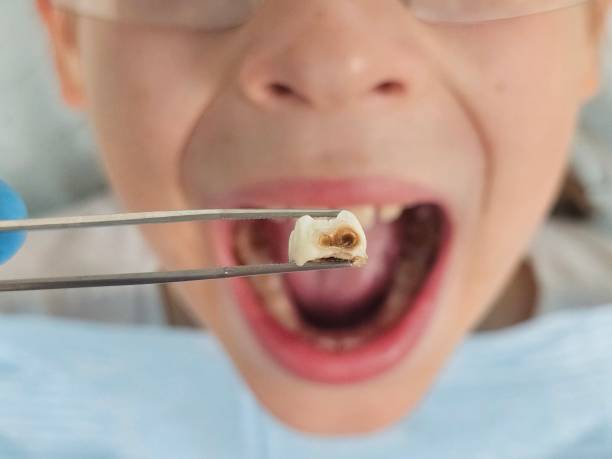 Best Emergency Wisdom Teeth Removal in Dell Rapids, SD